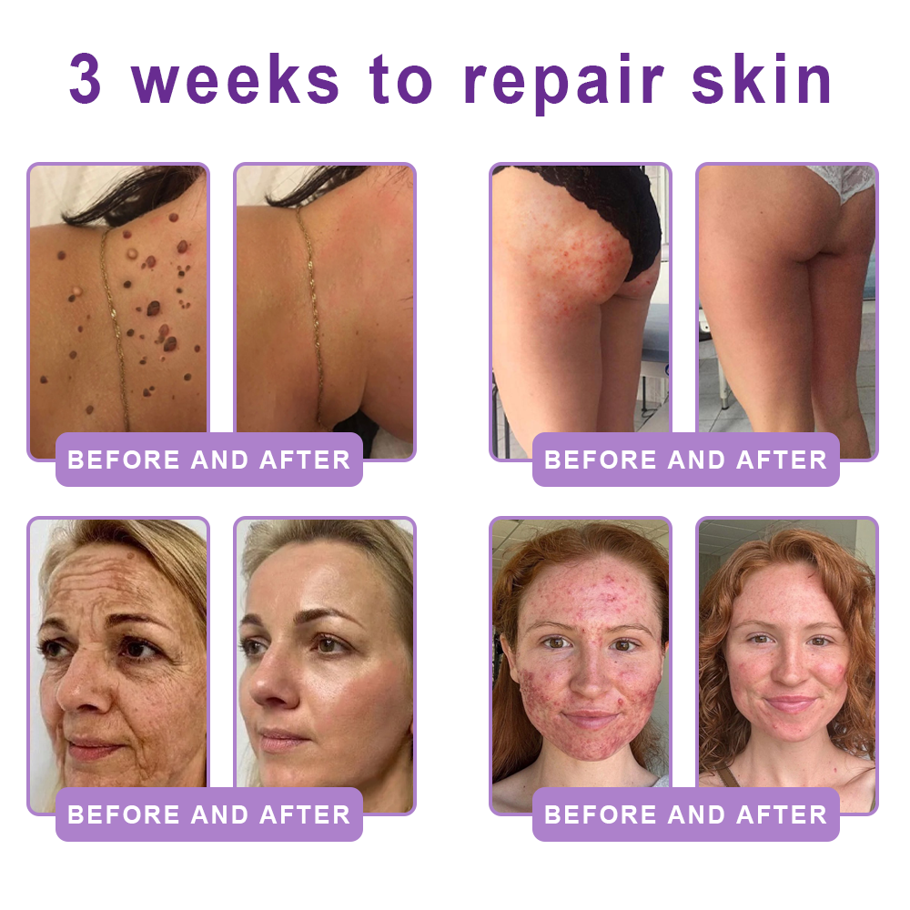 CE Certified: HISKIN® PDRN Multi-Peptide Massaging Body Roller Cream- Anti-aging, Hydrating, Skin Firming & Lifting, Skin Repair, Even Tone, Acne and Dark Spot Treatment, Wart and Mole Removal, and Psoriasis Relief.