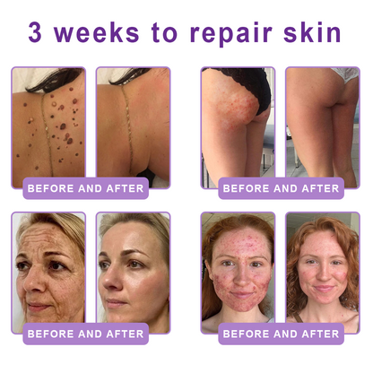 CE Certified: HISKIN® PDRN Multi-Peptide Massaging Body Roller Cream- Anti-aging, Hydrating, Skin Firming & Lifting, Skin Repair, Even Tone, Acne and Dark Spot Treatment, Wart and Mole Removal, and Psoriasis Relief.
