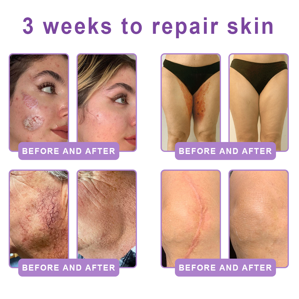 CE Certified: HISKIN® PDRN Multi-Peptide Massaging Body Roller Cream- Anti-aging, Hydrating, Skin Firming & Lifting, Skin Repair, Even Tone, Acne and Dark Spot Treatment, Wart and Mole Removal, and Psoriasis Relief.
