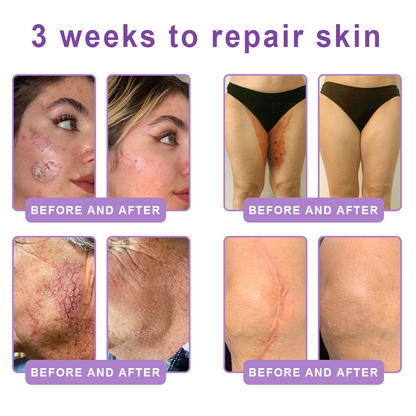 CE Certified: HISKIN® PDRN Multi-Peptide Massaging Body Roller Cream- Anti-aging, Hydrating, Skin Firming & Lifting, Skin Repair, Even Tone, Acne and Dark Spot Treatment, Wart and Mole Removal, and Psoriasis Relief.