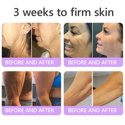 CE Certified: HISKIN® PDRN Multi-Peptide Massaging Body Roller Cream- Anti-aging, Hydrating, Skin Firming & Lifting, Skin Repair, Even Tone, Acne and Dark Spot Treatment, Wart and Mole Removal, and Psoriasis Relief.