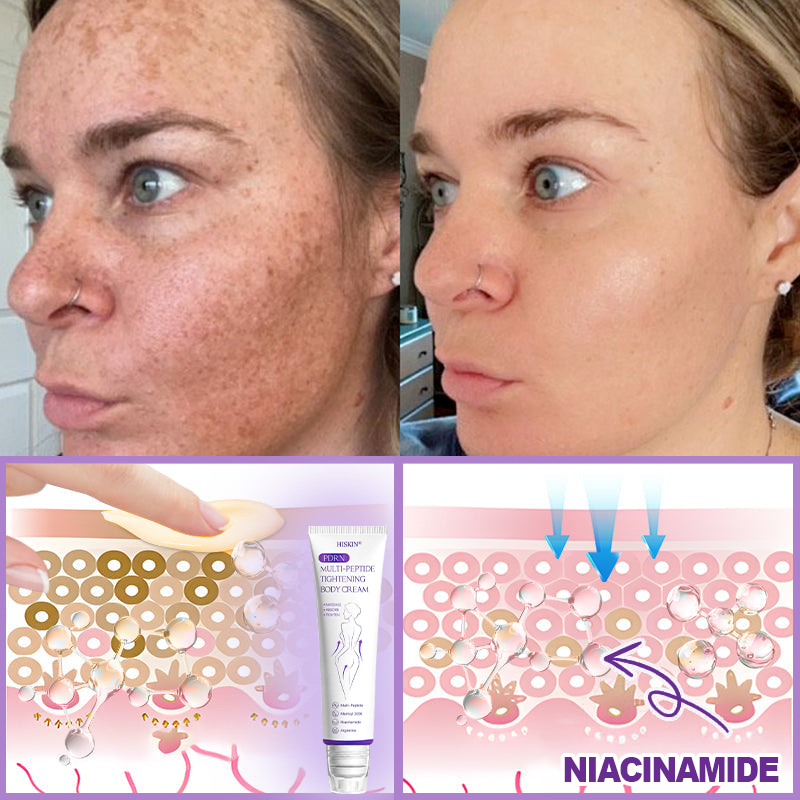 CE Certified: HISKIN® PDRN Multi-Peptide Massaging Body Roller Cream- Anti-aging, Hydrating, Skin Firming & Lifting, Skin Repair, Even Tone, Acne and Dark Spot Treatment, Wart and Mole Removal, and Psoriasis Relief.