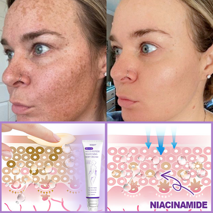 CE Certified: HISKIN® PDRN Multi-Peptide Massaging Body Roller Cream- Anti-aging, Hydrating, Skin Firming & Lifting, Skin Repair, Even Tone, Acne and Dark Spot Treatment, Wart and Mole Removal, and Psoriasis Relief.