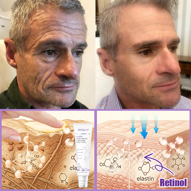 CE Certified: HISKIN® PDRN Multi-Peptide Massaging Body Roller Cream- Anti-aging, Hydrating, Skin Firming & Lifting, Skin Repair, Even Tone, Acne and Dark Spot Treatment, Wart and Mole Removal, and Psoriasis Relief.